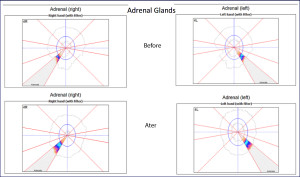 Adrenals, Before & After Treatment